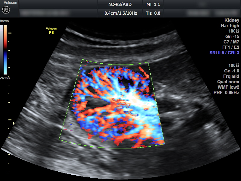 УЗДГ почечных сосудов