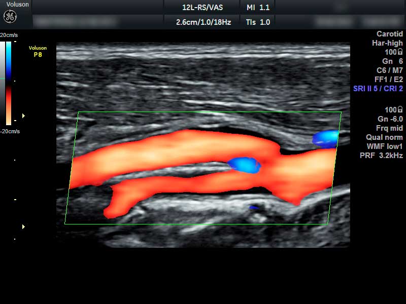 УЗИ сосудов шеи