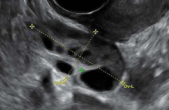 Фолликулометрия